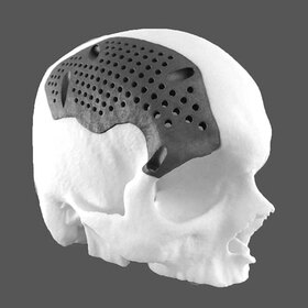 3D printed cranial implant